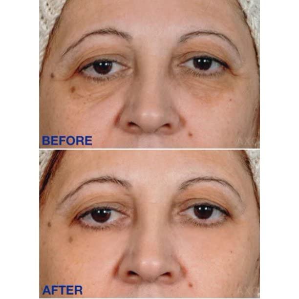 Age-Defying Under-Eye Serum | Best Instant Wrinkle Remover | Advanced Formula Anti Aging Visibly Reduces Under Eye Wrinkles, Bags, Dark Circles, Fine Lines & Crow’s Feet | 100% All-Natural