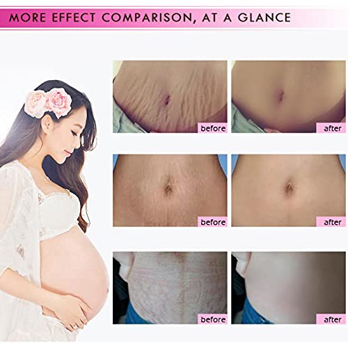 Mango Stretch Marks and Scar Cream, Stretch Marks and Scar Removal Cream for Pregnancy, Stretch Marks Scar Belly Creams for Wrinkles, Obesity Fat Stretch Mark Moisturizing, Remove Marks (40g)