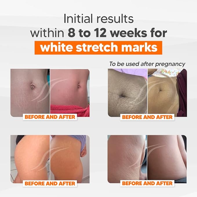 Cicatrissim Deep Stretch Mark Removal Cream - Innovative Formula With Pure and Powerful Natural Ingredients From Brazilian Flora - For All Stretch Marks & Skin Types.