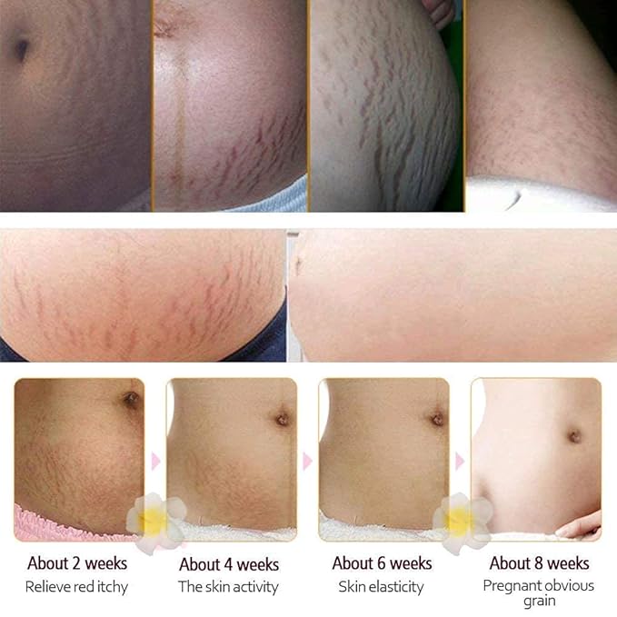 RtopR Mango Stretch Marks and Scar Cream -Stretch Marks and Scar Removal Cream for Pregnancy - Best Body Moisturizer-80g
