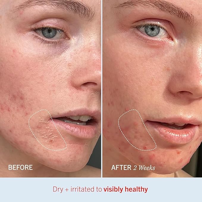 First Aid Beauty - Ultra Repair Cream, Intense Hydration Whipped Colloidal Oatmeal, Clinically Proven to Strengthen Skin Barrier & Help Relieve Eczema, Face & Body Moisturizer, 14oz Juicy Peach