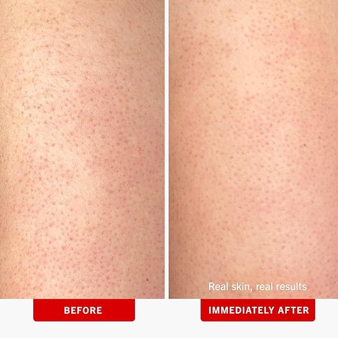 First Aid Beauty - KP Bump Eraser Body Scrub with 10% AHA, Keratosis Pilaris Skin Exfoliator with Glycolic and Lactic acids, Helps Reduce Chicken Skin Bumps, Safe for Sensitive Skin, 8 oz