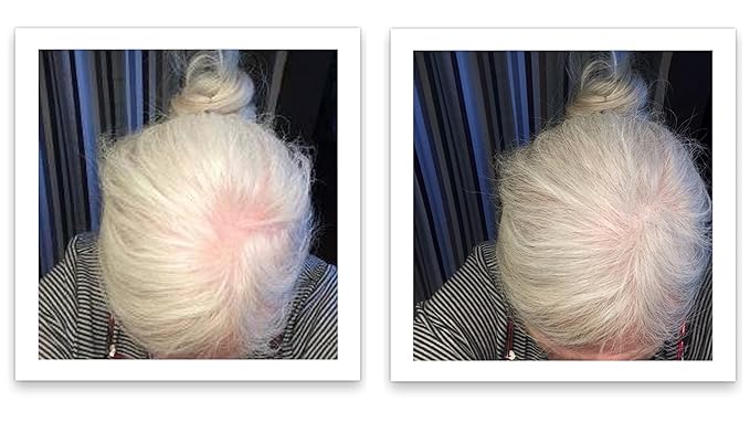 Hair Thickening Fibers. Cover Bald Spot and Thinning Hair Instantly. Make Thin Hair Look 10X Fuller. All-Natural Hair Building Fiber. Trial Size (10-Day Supply). Silver/White