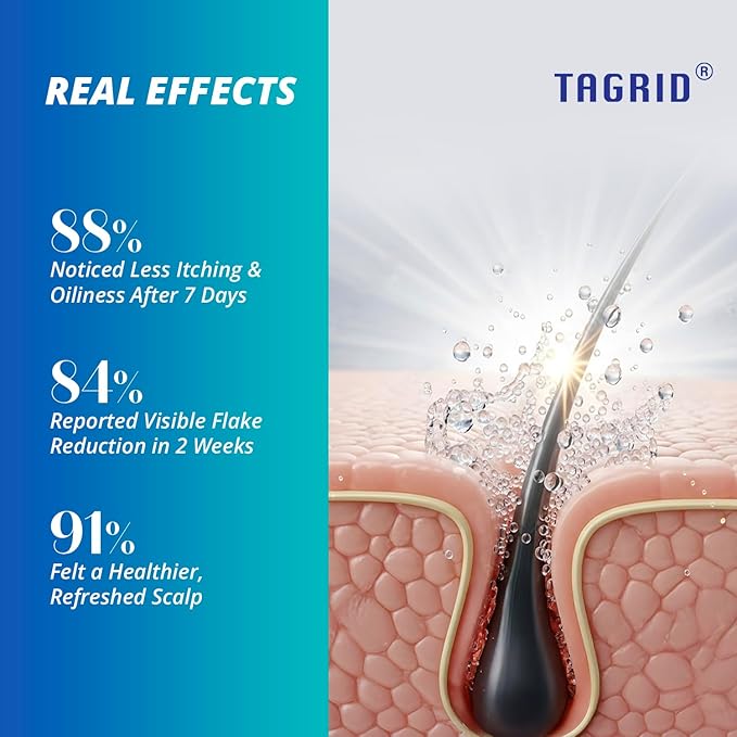 TAGRID Anti-Fungal Shampoo 300mL – Scalp Treatment for Psoriasis, Seborrheic Dermatitis, Folliculitis, Dandruff & Itchy Flaky Scalp – Soothing Plant-Based Formula for Men & Women