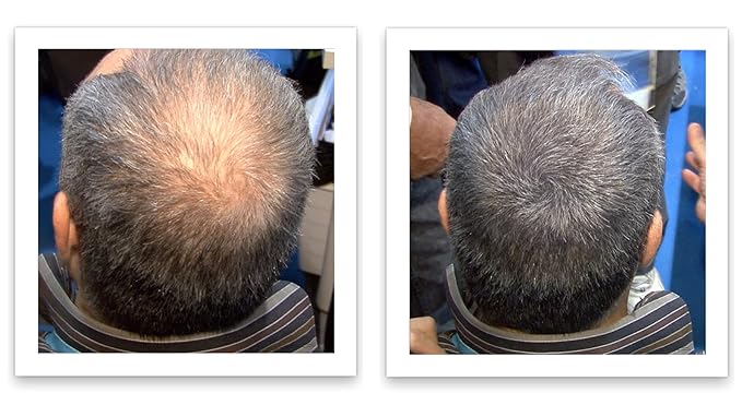 Trial Size - Eliminate Bald Spot and Thinning Hair Instantly. Make Thin Hair Look 10X Fuller. All-Natural Hair Thickening Fiber. Salt & Pepper - Dark