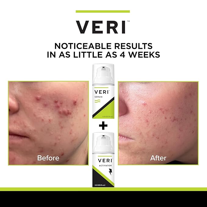 VERI Nitric Oxide + Salicylic Acid Clear Skin System (Peroxide-Free): For Acne Prone Skin, Unclogs Pores, Clarifies Blemishes, Reduces Inflammation, Prevent Future Breakouts, 30 mL / 1 oz