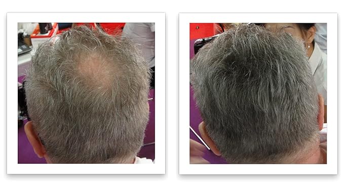 Hair Loss Concealer. Covers Bald Spot And Makes Thin Hair Look 10X Fuller Instantly. All-Natural Hair Building Fiber. Trial Size, 10-Day Supply. Gray
