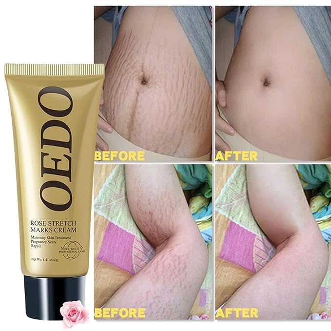 Rose Remove Stretch Marks Cream for Pregnancy Scar Removal Cream Natural Plant Essence Formula Prevention Remove Stretch Mark Old Scars Body Moisturizer 40g