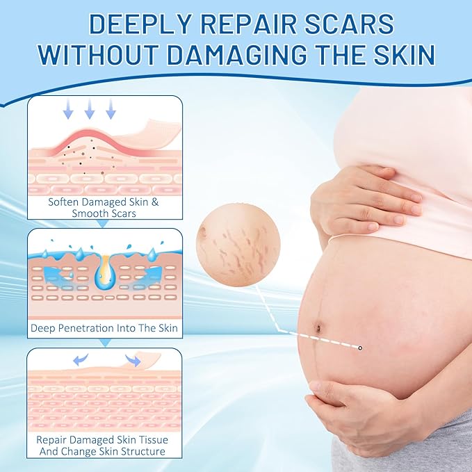 Stretch Mark Removal, Stretch Mark Cream for Pregnancy, Scar Removal Cream Deep Stretch Mark Removal, Belly Butter for Pregnant Women To Prevent And Repair Maternity Stretch Marks Scar 2.82 Oz