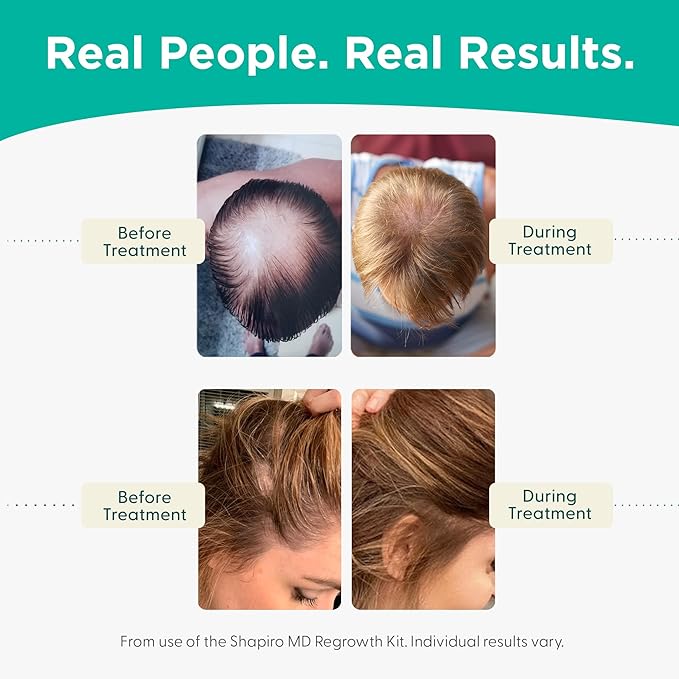 Shapiro MD Hair Growth Experts Hair Loss Shampoo and Conditioner, DHT Fighting Vegan Formula for Thinning Hair Developed by Dermatologists, Experience Healthier & Thicker Hair - 2 Month Supply