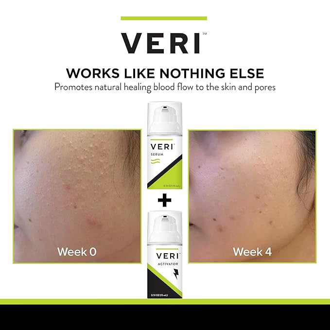 VERI Nitric Oxide + Salicylic Acid Clear Skin System (Peroxide-Free): For Acne Prone Skin, Unclogs Pores, Clarifies Blemishes, Reduces Inflammation, Prevent Future Breakouts, 30 mL / 1 oz