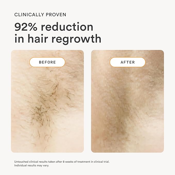 NEW Nood™ Flasher 2.0 Kit — IPL Laser Hair Removal Device for Women & Men — Pain-free & Permanent, Visible Results After First Use & Works Everywhere — Pre & Post IPL Treatment Included — Matte Black