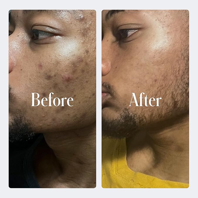 Geologie Clear System | 3-Step Acne Treatment & Skincare Set | Clears Skin Fast | Acne Gel Cleanser, SPF15 Day Cream & .2% Retinol Face Cream For Men & Women | Month 2 / Level 2