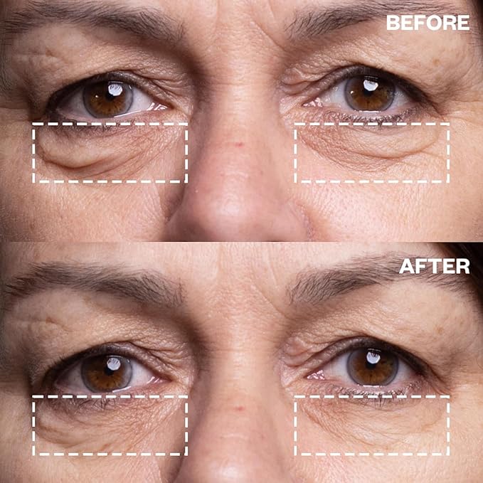 Wrinkles Schminkles Under Eye Wrinkle Patches, Smooth Eye Wrinkles, Crows Feet & Dark Circles Overnight, 1 Pair Reusable Medical Grade Silicone Patches