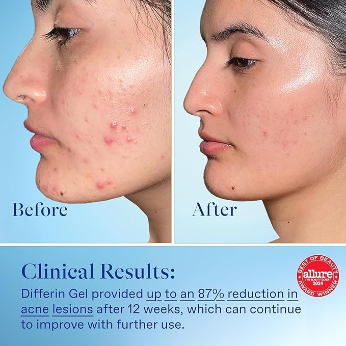 Differin Acne Treatment Gel, 180 Day Supply, Retinoid Treatment for Face with 0.1% Adapalene, Gentle Skin Care for Acne Prone Sensitive Skin, 45g Tube, Pack of 2 (Packaging May Vary)
