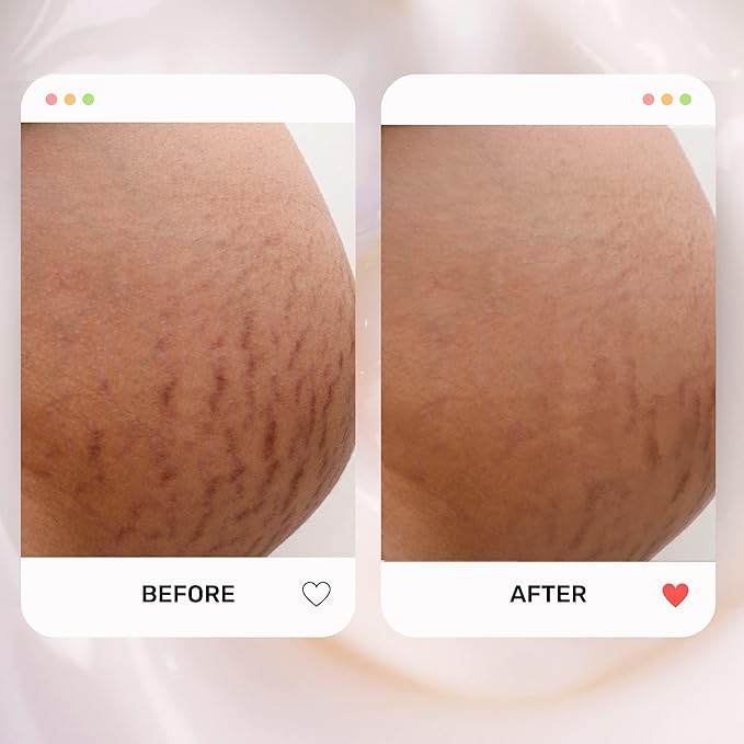 S1 Stretch Mark Cream, 150ml / 5oz, Lightweight Pregnancy Stretch Mark Cream