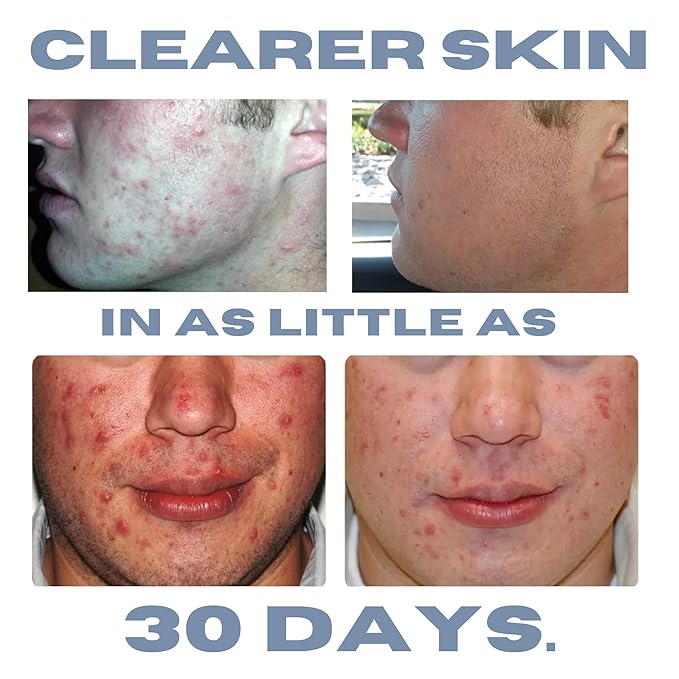 Acne Treatment Kit, Acne Kit, Skin Care Acne, Acne Skin Care Set, Natural Anti-DHT Deluxe Set Sensitive Skin 3-Piece Set, 2-Month Supply