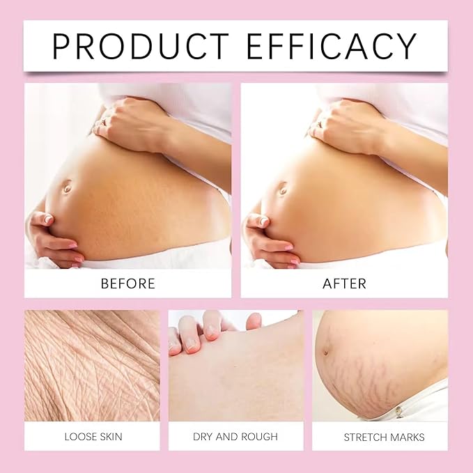 Stretch Mark Pregnancy Oil, Natural Oil Skincare Body Oil Serum for Scars and Stretch Marks, Face with Vitamin E & A for Sensitive Dry Skin and Body Moisturizer