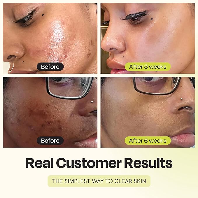 Gleamin Vitamin C Clay Mask for Dark Spots, Turmeric Clay Face Mask Skin Care, Deeply Cleanses & Refines Pores, Brightens Uneven Tone and Helps Improve Post-Blemish Scarring & Texture, Up to 20 Uses