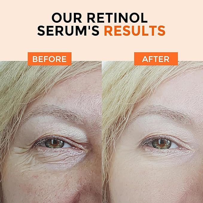 Face Serum Set – Retinol Serum & Hyaluronic Acid for Face – Anti Aging Skin Care Set for Women – Firm, Wrinkle Smoothing