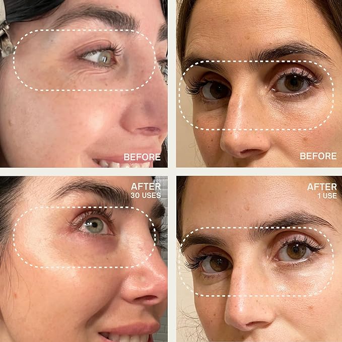 Dermaclara Face Patches Kit - Anti Wrinkle Patches for Forehead, Smile Lines, Silicone Anti-Wrinkle Frown Line Treatment, Up to 30 Uses - 1 Forehead, 2 Mouth, 2 Eye, 1 Neck & 1 Patch Prep Cleanser