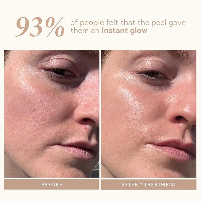 SHANI DARDEN SKIN CARE Triple Acid Peel, 2-Step Exfoliating Face Peel with Mandelic, Lactic & Glycolic Acids, Kaolin Clay Neutralizing Mask & Brush, Helps Improve Dark Spots & Skin Texture, 1.69 fl oz