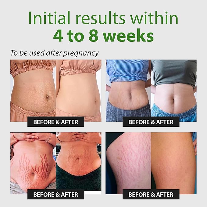 Abera Ovela Maternity Stretch Mark Cream for Pregnancy and Weight Fluctuations, Stretch Mark Treatment Pregnancy Must Haves, Deep Stretch Mark Removal, All Skin Types, 1.69 fl oz
