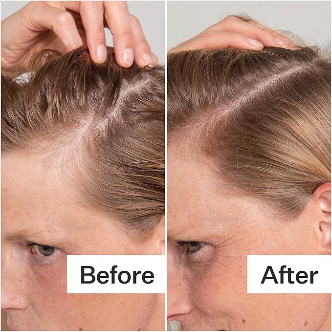 ACT+ ACRE Cold Processed Salicylic Acid Exfoliator | For Loose Flakes, Excess Oil, Scalp Build-Up | Salicylic Acid, Papaya, Peppermint | Balance, Soothe | Vegan, Color Safe, Fragrance-Free | 2 Fl Oz