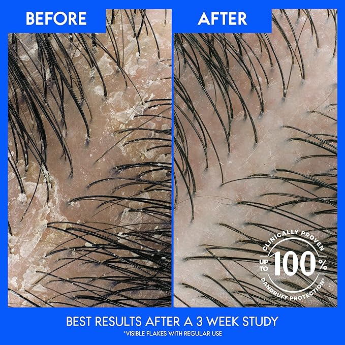 Head & Shoulders Itchy Scalp Care Dandruff Shampoo, Anti-Dandruff Treatment, Infused with Eucalyptus, 32.1 Fl Oz Each, Twin Pack